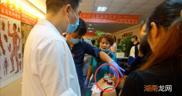 背部中医刺络放血疗法