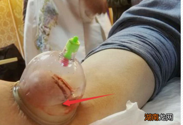 背部中医刺络放血疗法