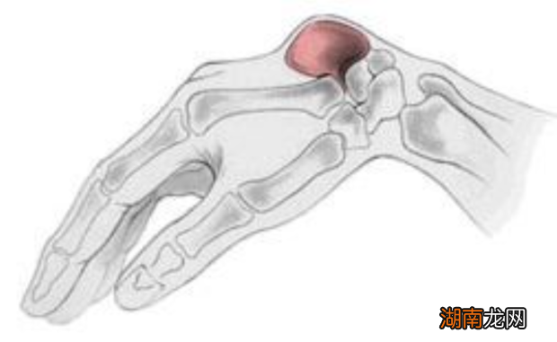 怎么治疗腱鞘囊肿