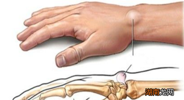 怎么治疗腱鞘囊肿