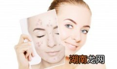 吃什么可以祛痘 吃哪些食物可以祛痘