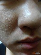 脸上起白皮的原因是什么 洗完脸后脸上起白皮怎么办