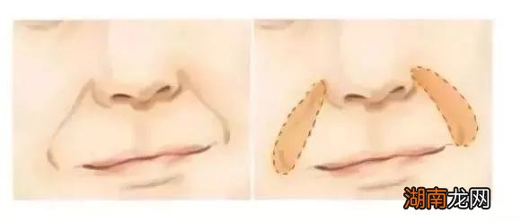 木偶纹形成的五个主要原因 嘴角两边的纹叫什么纹