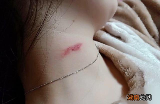 草莓印一般指的是吻痕 脖子上的草莓印是什么意思