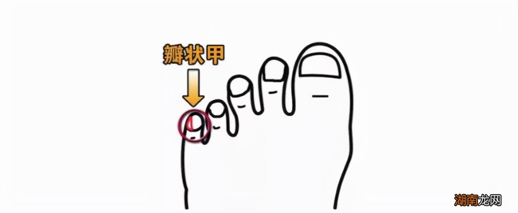 小脚趾甲被分两瓣是什么原因 小脚趾甲两瓣的来历