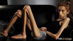 体重40斤：堪称行走的骷髅 世界上最瘦的人是谁图片