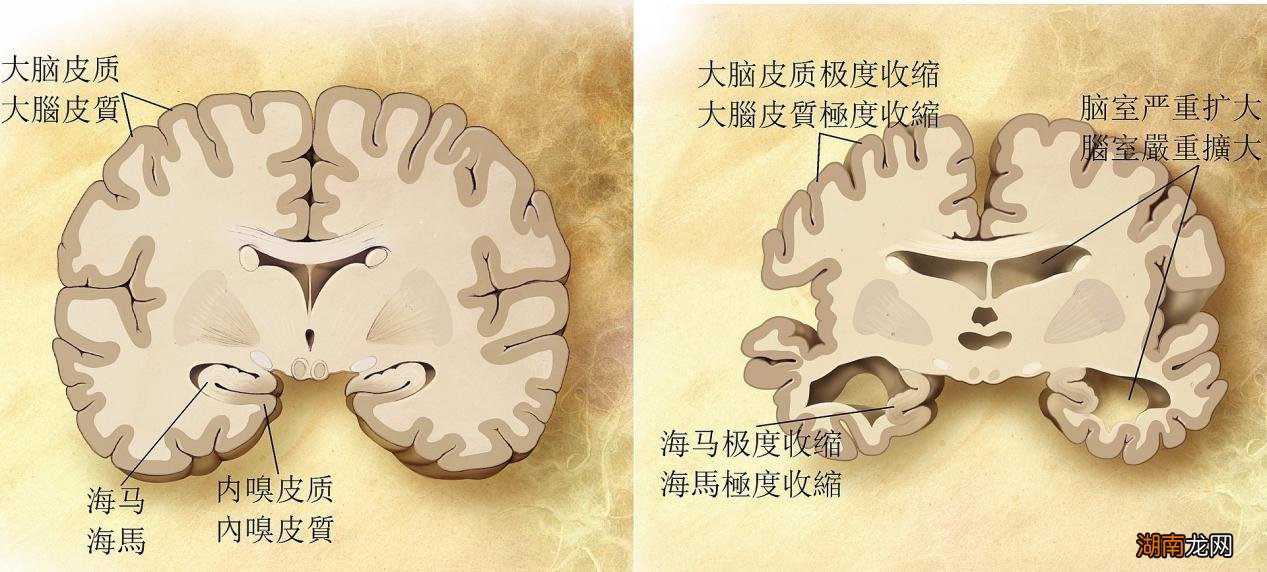 你对老年痴呆症了解多少?它与教育水平、睡眠,甚至体重密切相关