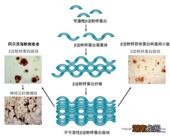 你对老年痴呆症了解多少?它与教育水平、睡眠,甚至体重密切相关