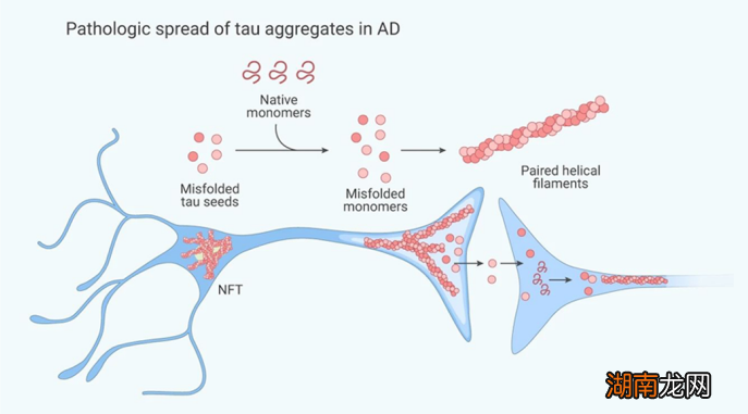 你对老年痴呆症了解多少?它与教育水平、睡眠,甚至体重密切相关