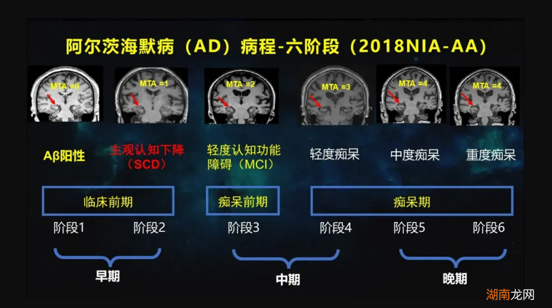 你对老年痴呆症了解多少?它与教育水平、睡眠,甚至体重密切相关