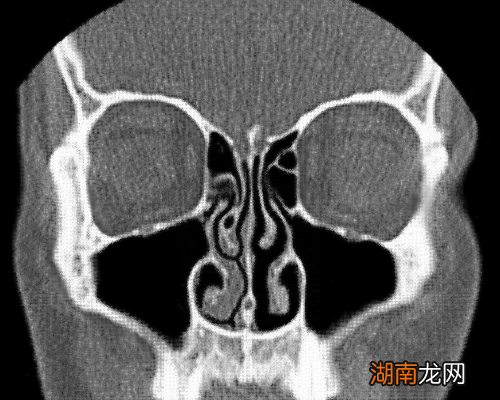 鼻子不通气?你关于鼻塞的理解可能都是错的……