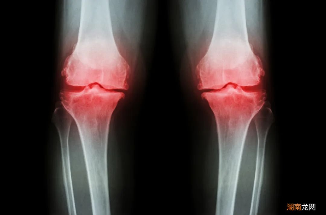 既不跑也不跳,这个动作居然最伤膝盖?很多人避免不了……