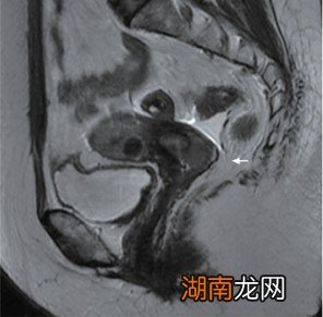 HPV、癌症、局部晚期、放疗……58岁的这一年，好像又重新活过一次
