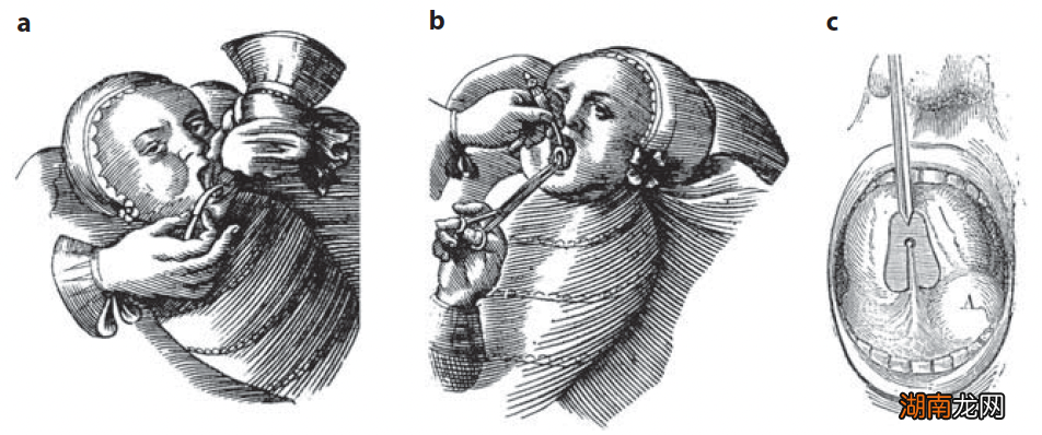 美国妈妈流行给婴儿舌头划一刀,还说这能“治百病”?