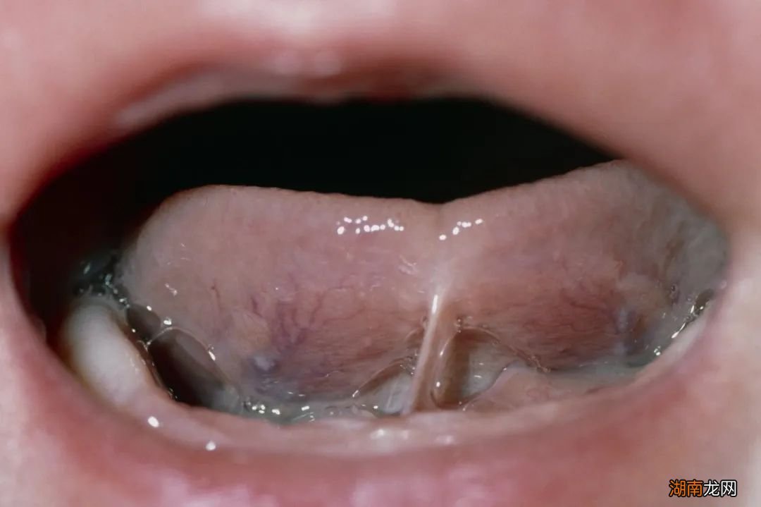 美国妈妈流行给婴儿舌头划一刀,还说这能“治百病”?