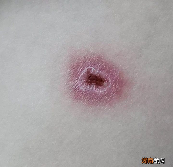 抱着热水袋睡觉，10岁小孩被烫伤！收好这份冬季取暖指南→