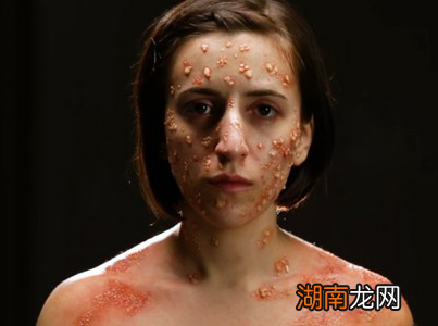 古代天花是怎么出现的 这种病为什么现在看不到了