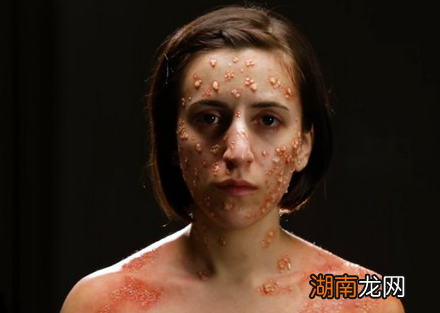 古代天花到底是什么病 为何古人如此的害怕天花